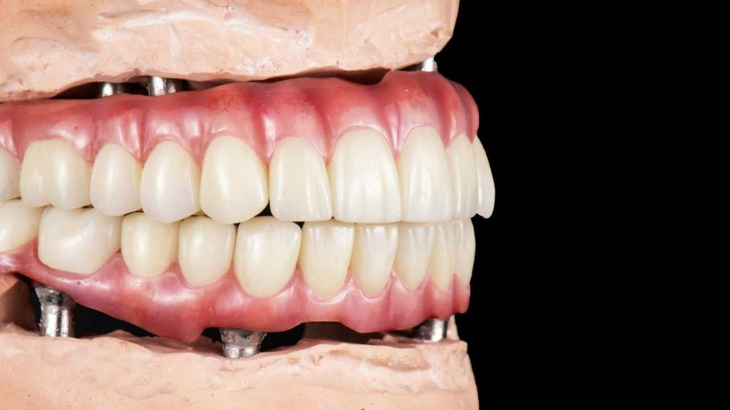Prothèse complète implanto-portée ALL on X à Marrakech - Laboratoire ELWAFA DENTAL