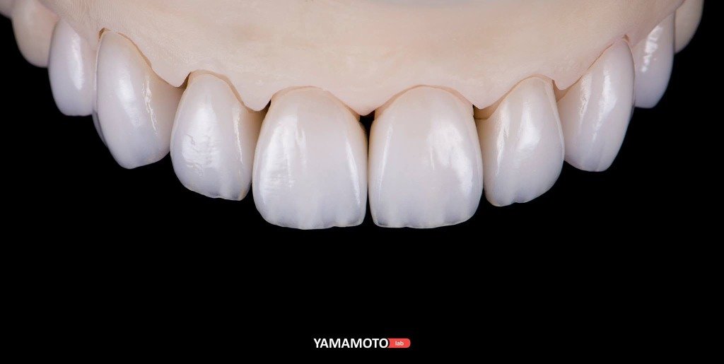 Facette en disilicate de lithium IPS e.max à Marrakech - ELWAFA DENTAL
