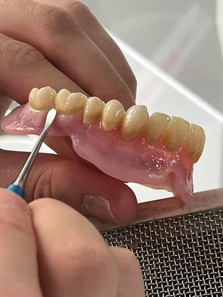 Prothèse adjointe complète amovible PAT avec esthétique gingivale à Marrakech - ELWAFA DENTAL